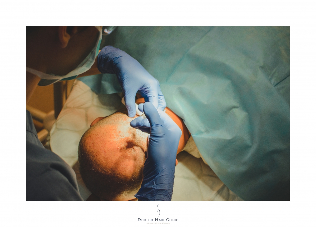 FUE hajbeültetés menete