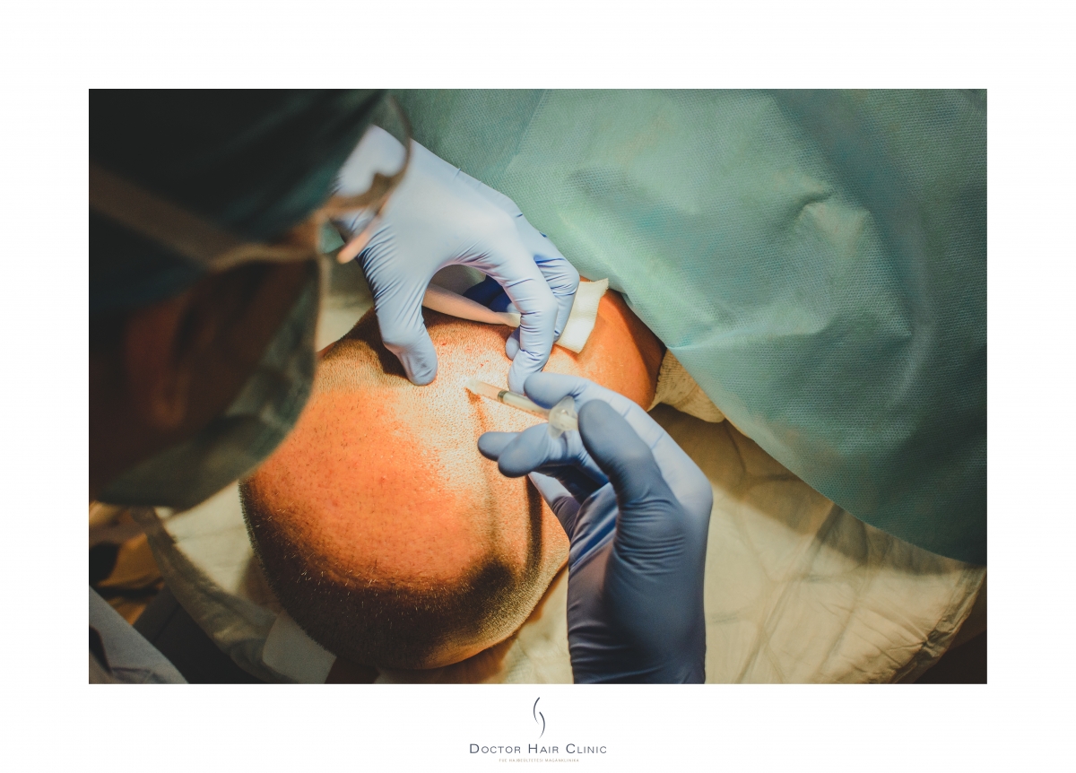 FUE hajbeültetés menete