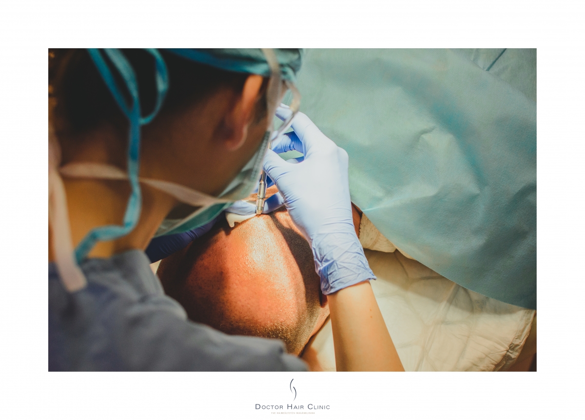 FUE hajbeültetés menete