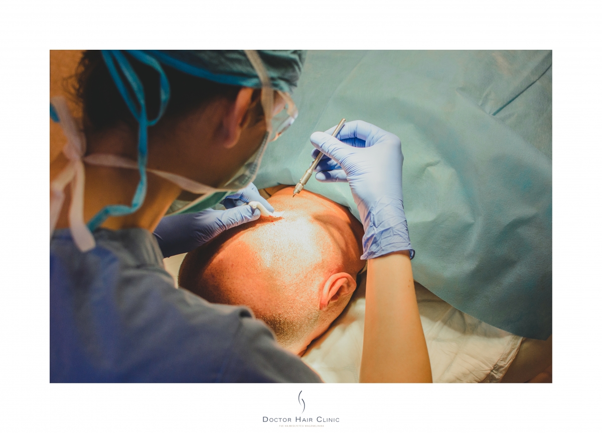 FUE hajbeültetés menete