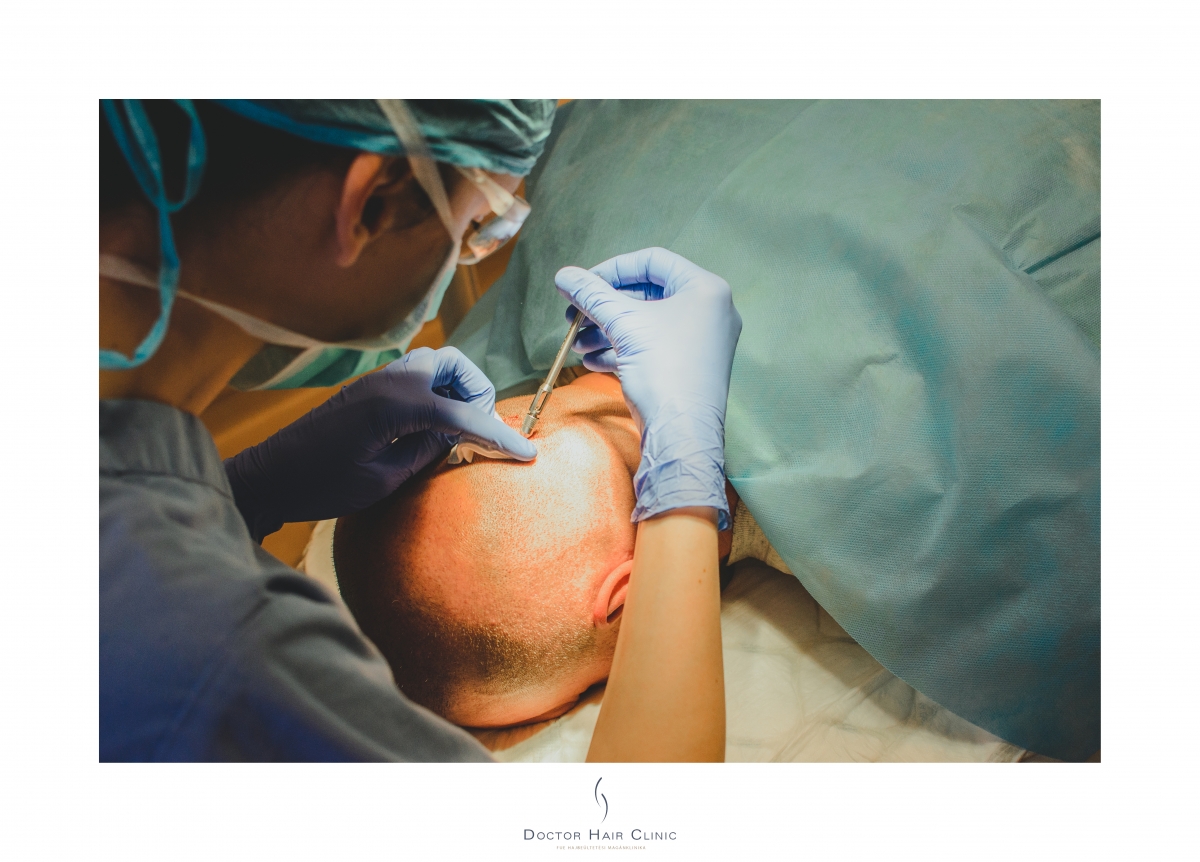 FUE hajbeültetés menete