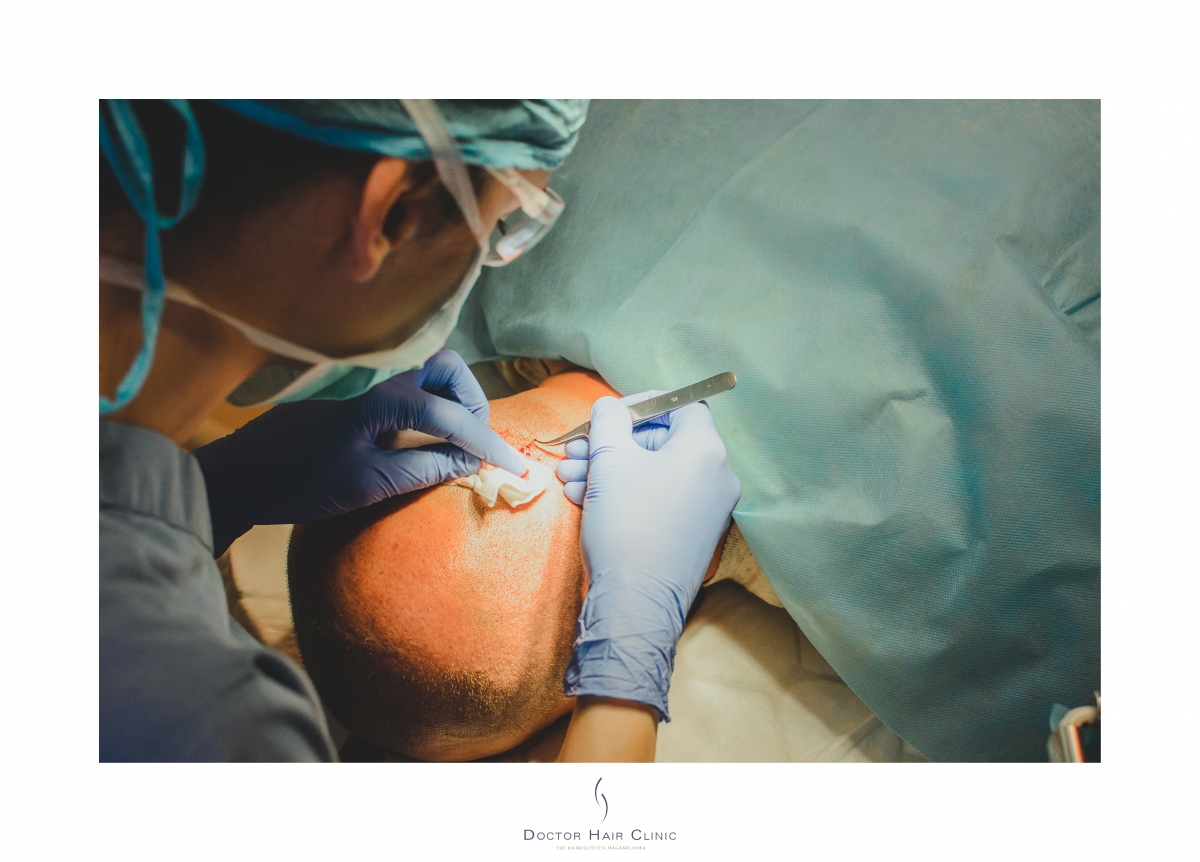 FUE hajbeültetés menete