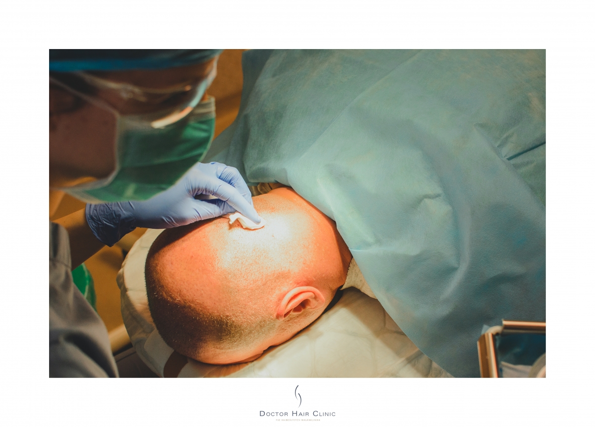 FUE hajbeültetés menete