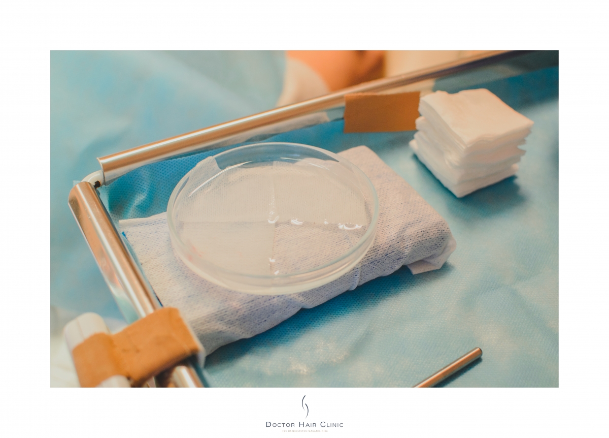 FUE hajbeültetés menete