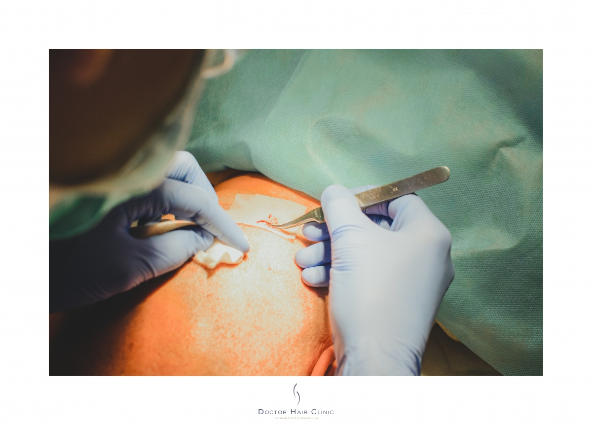 FUE hajbeültetés menete