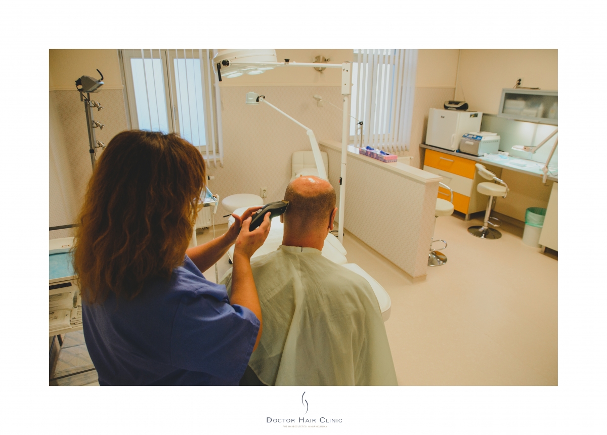 FUE hajbeültetés menete