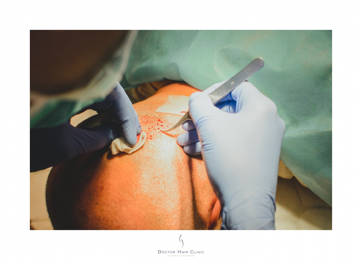 FUE hajbeültetés menete