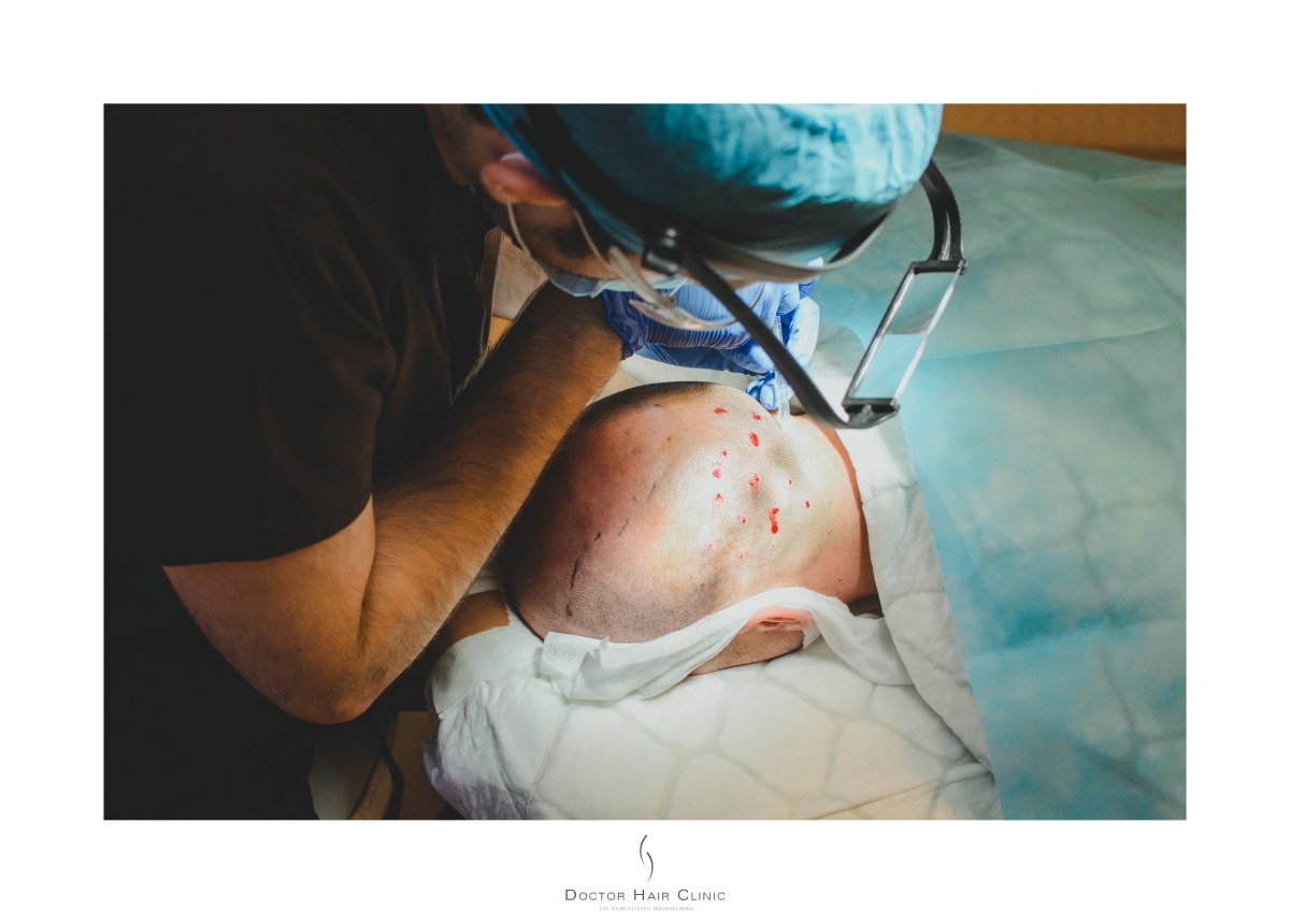 FUE hajbeültetés menete