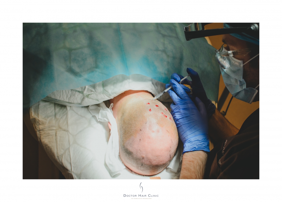 FUE hajbeültetés menete