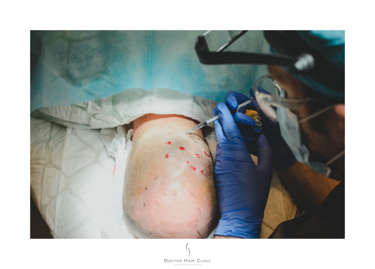 FUE hajbeültetés menete