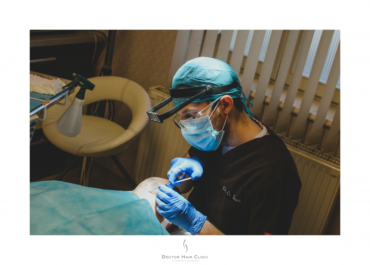 FUE hajbeültetés menete