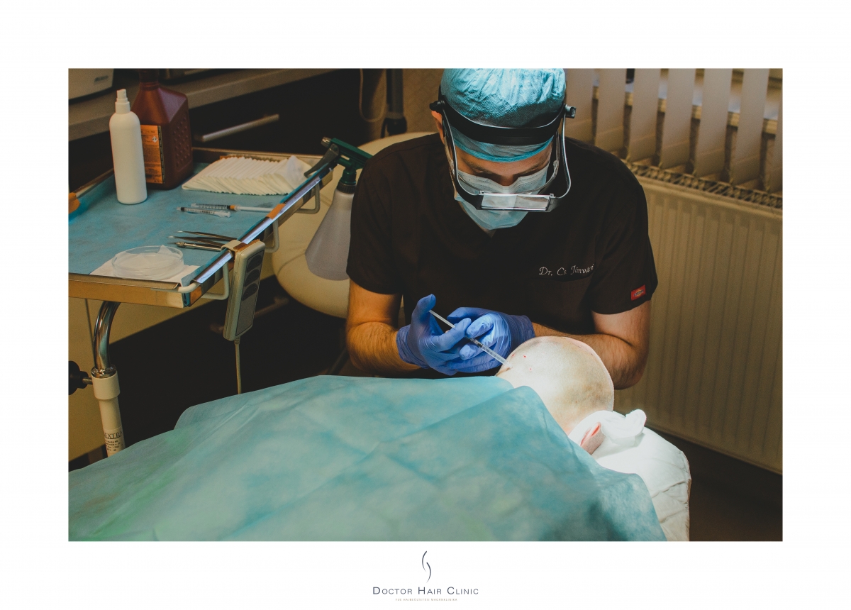 FUE hajbeültetés menete