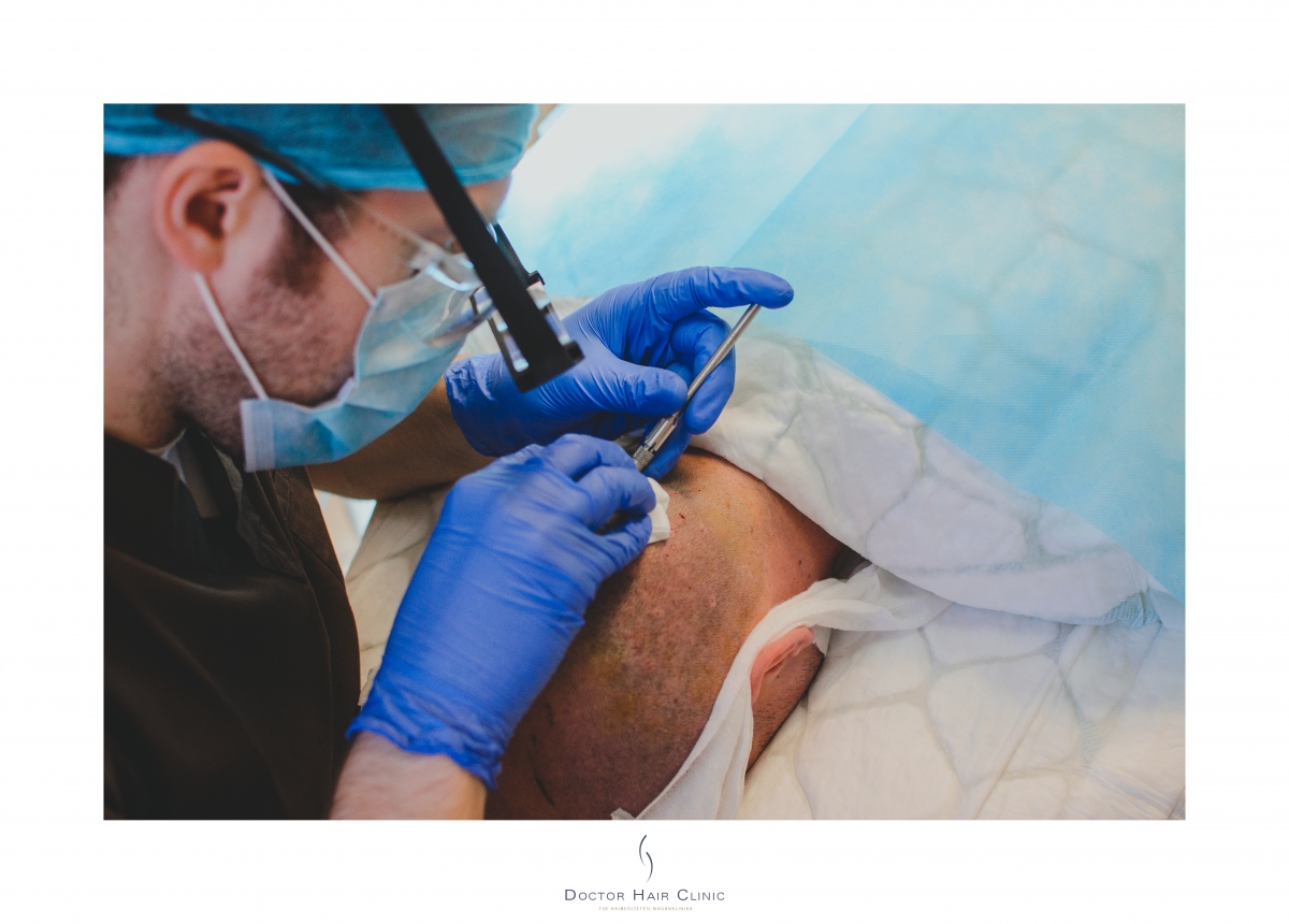 FUE hajbeültetés menete