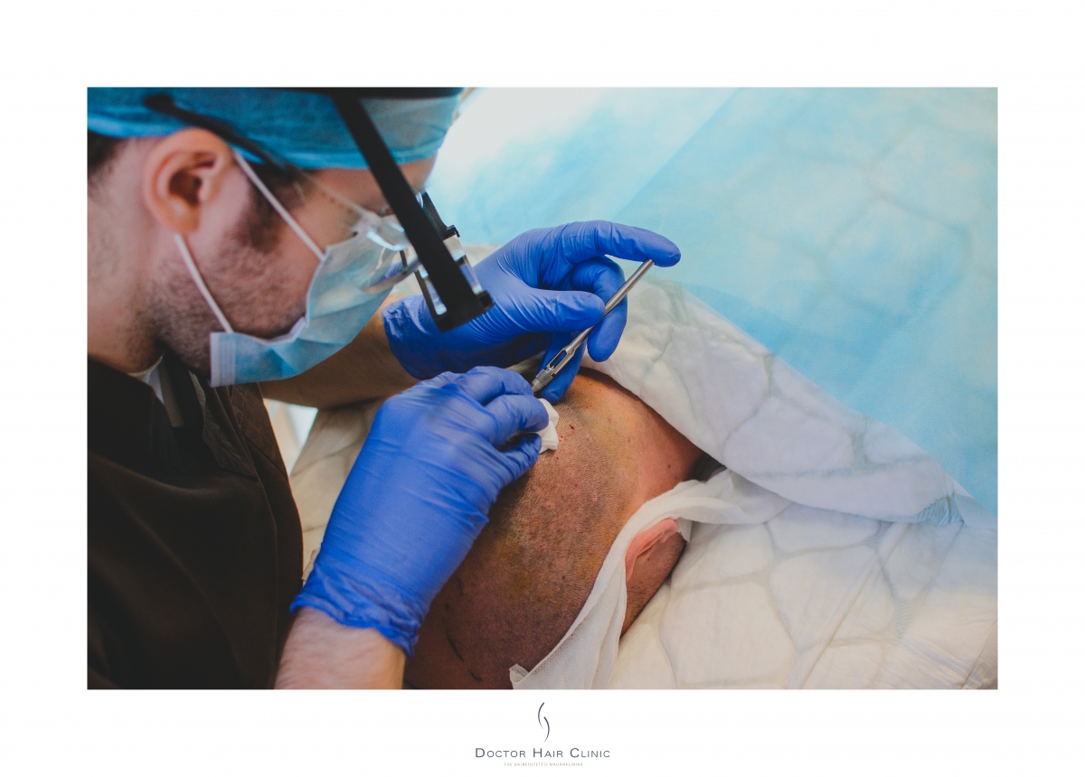 FUE hajbeültetés menete