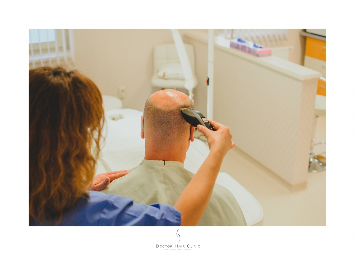 FUE hajbeültetés menete