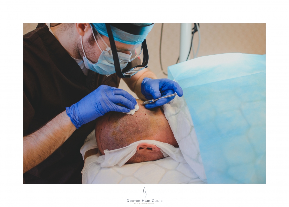 FUE hajbeültetés menete