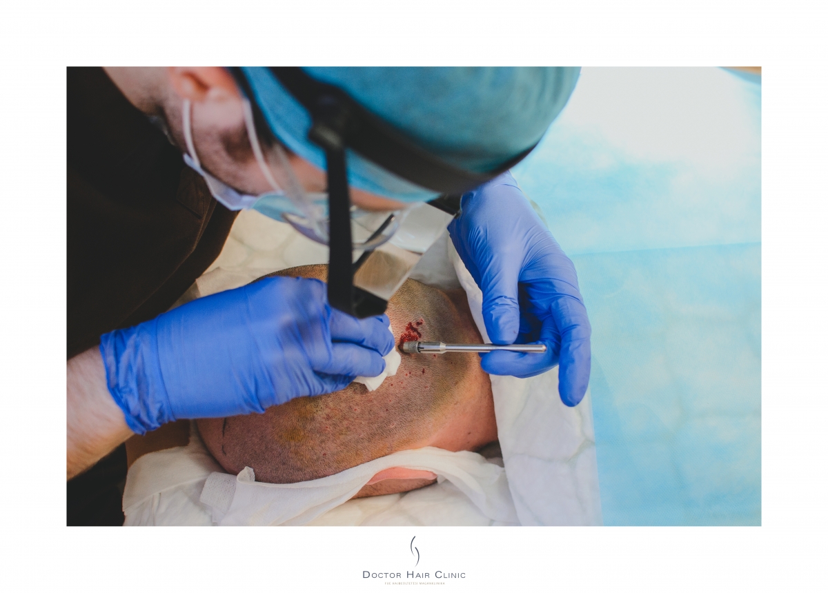 FUE hajbeültetés menete