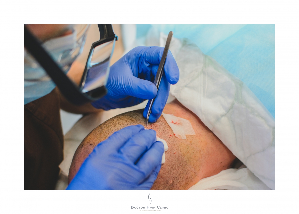 FUE hajbeültetés menete