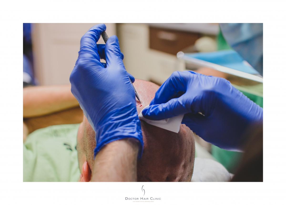 FUE hajbeültetés menete