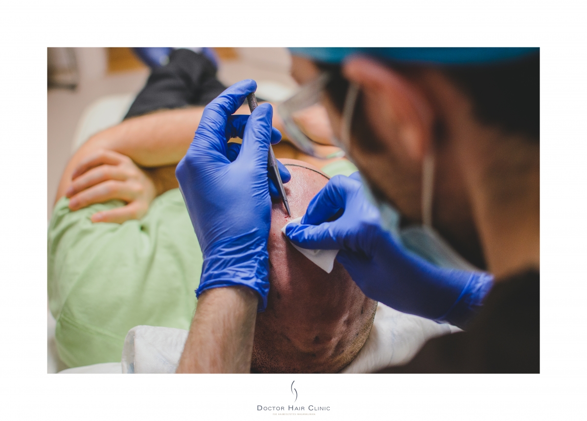 FUE hajbeültetés menete