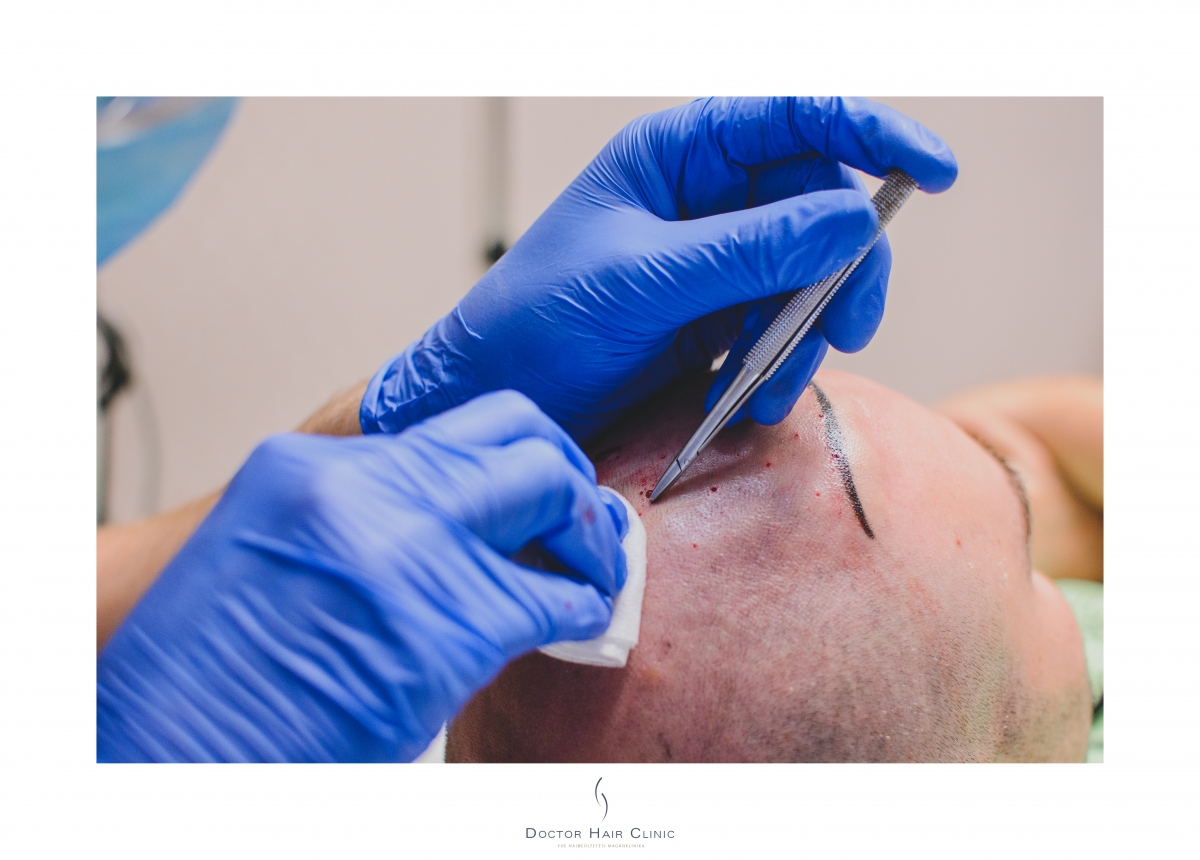 FUE hajbeültetés menete