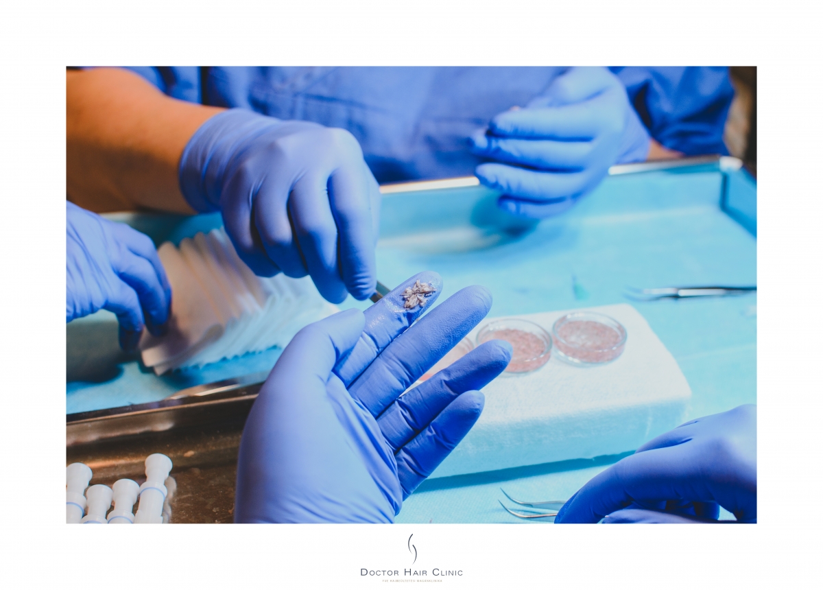 FUE hajbeültetés menete