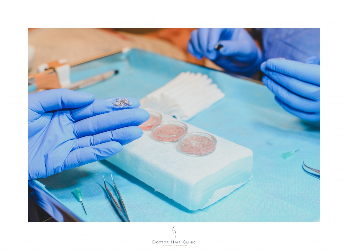 FUE hajbeültetés menete