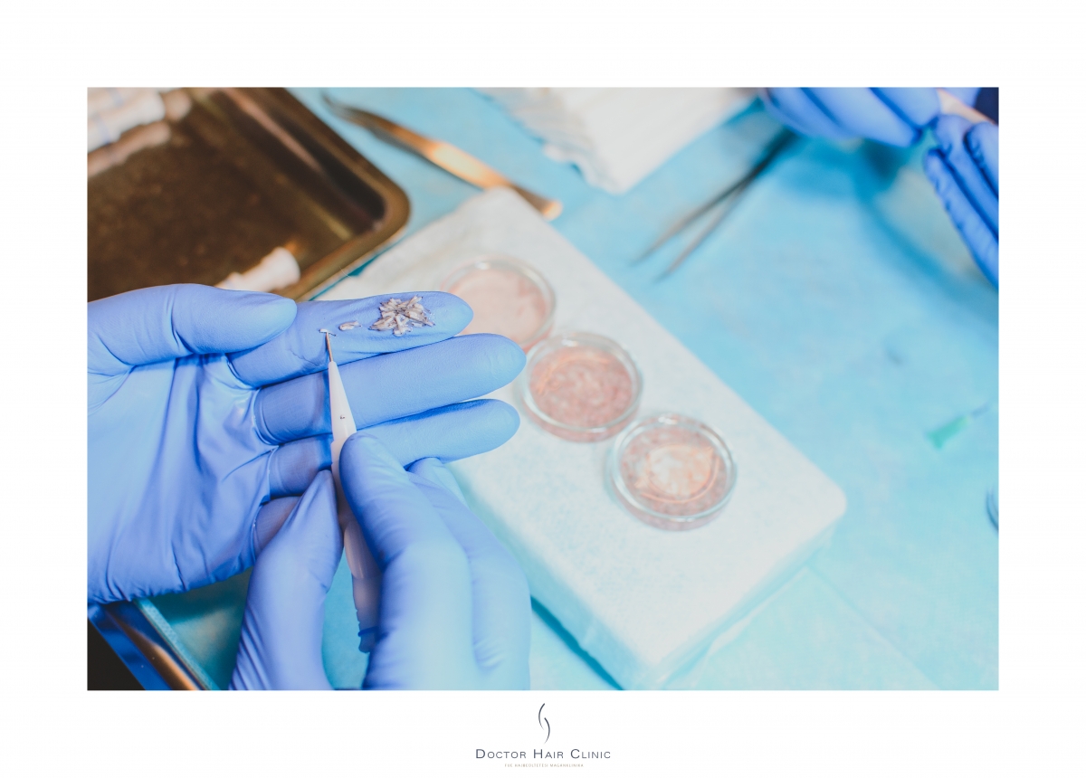 FUE hajbeültetés menete