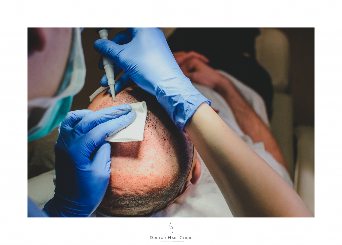 FUE hajbeültetés menete