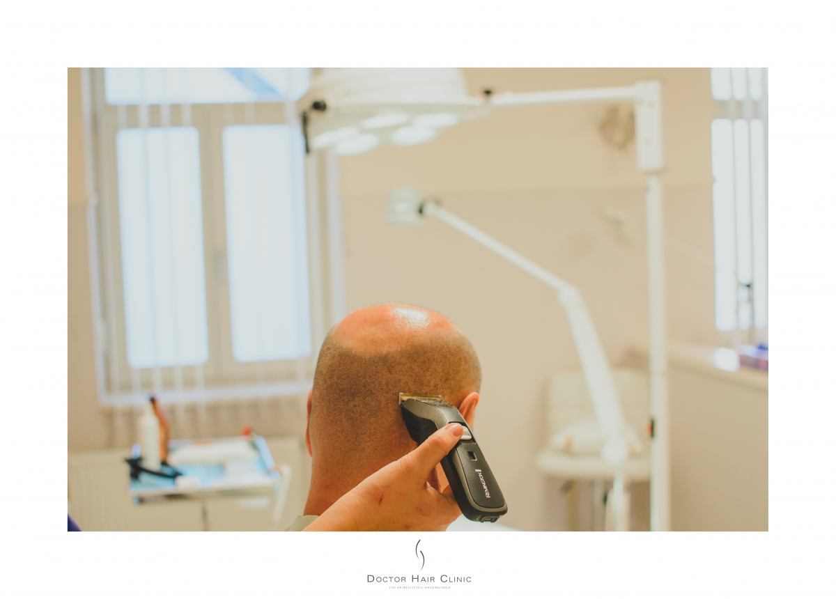 FUE hajbeültetés menete