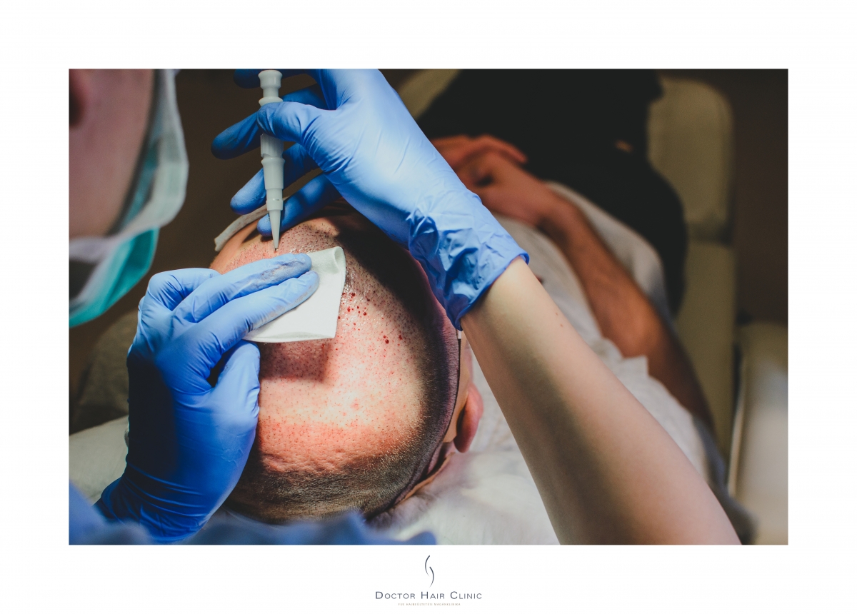 FUE hajbeültetés menete