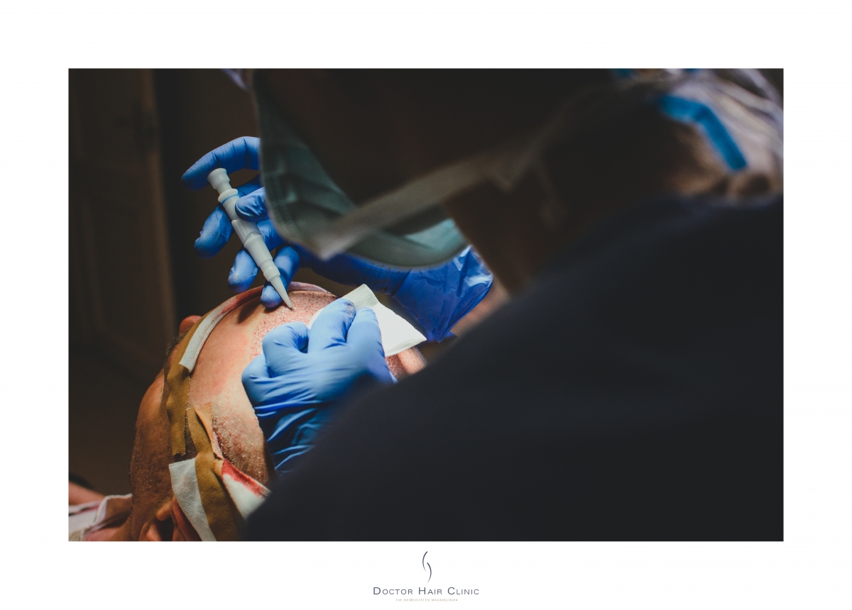 FUE hajbeültetés menete