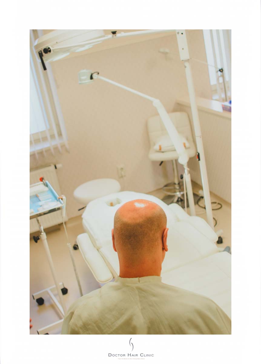 FUE hajbeültetés menete