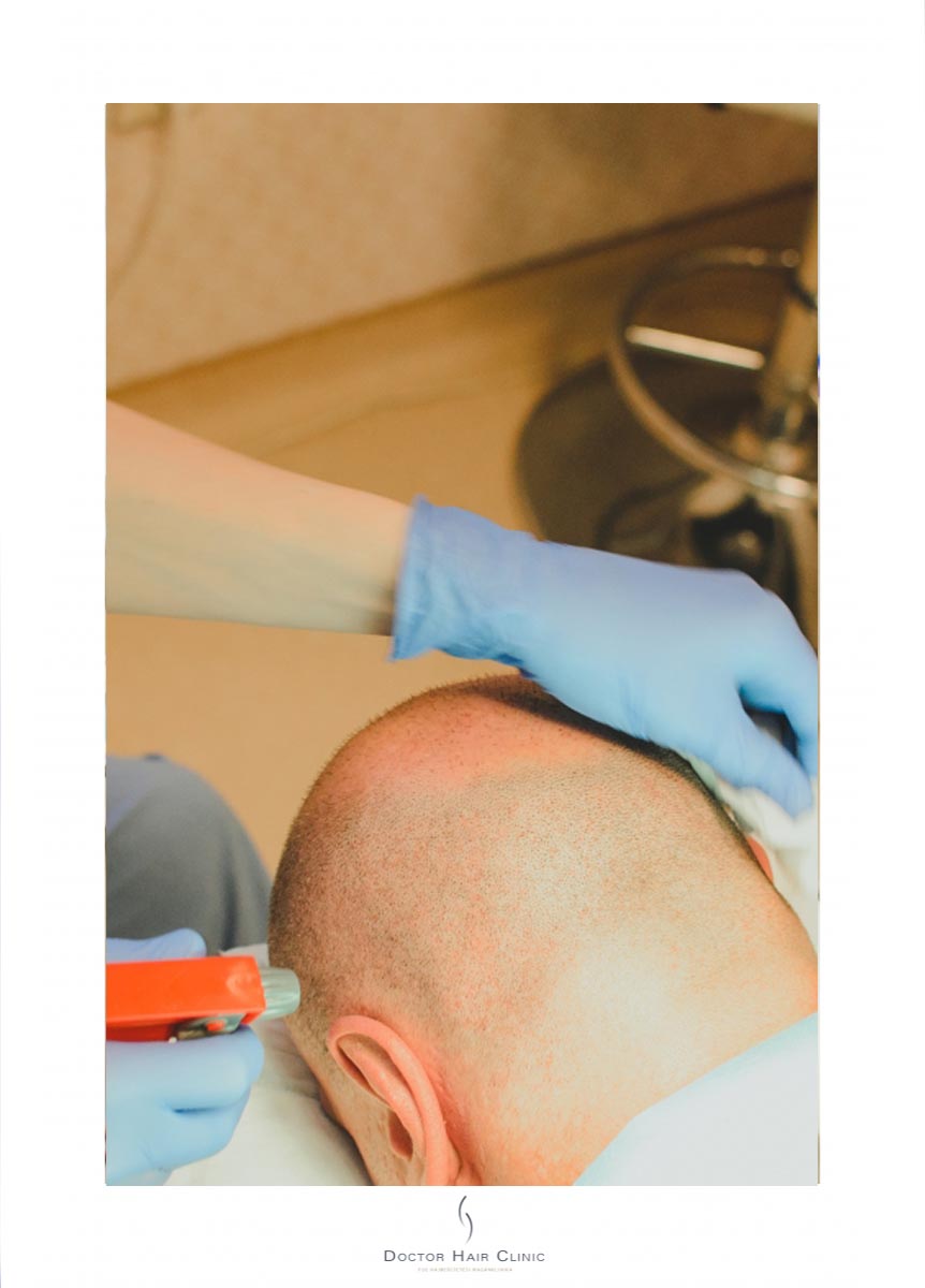 FUE hajbeültetés menete