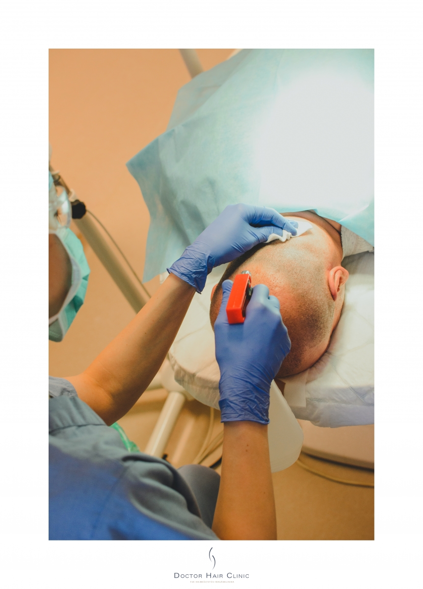 FUE hajbeültetés menete