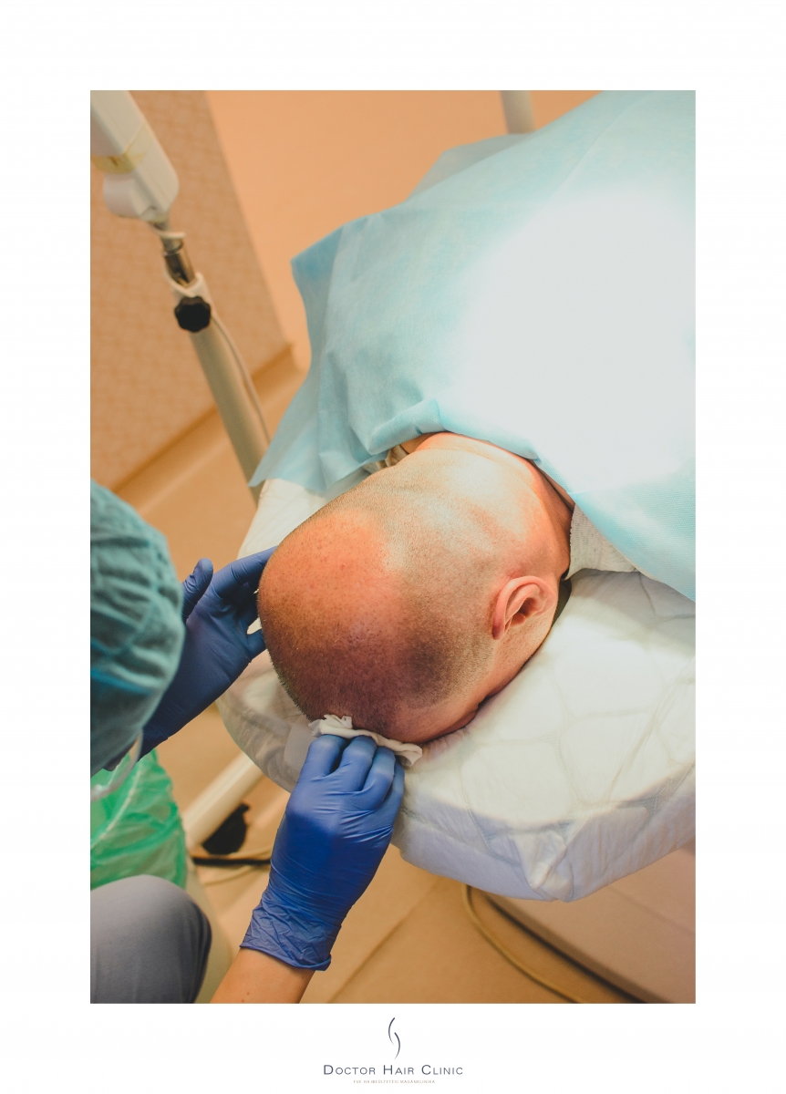 FUE hajbeültetés menete