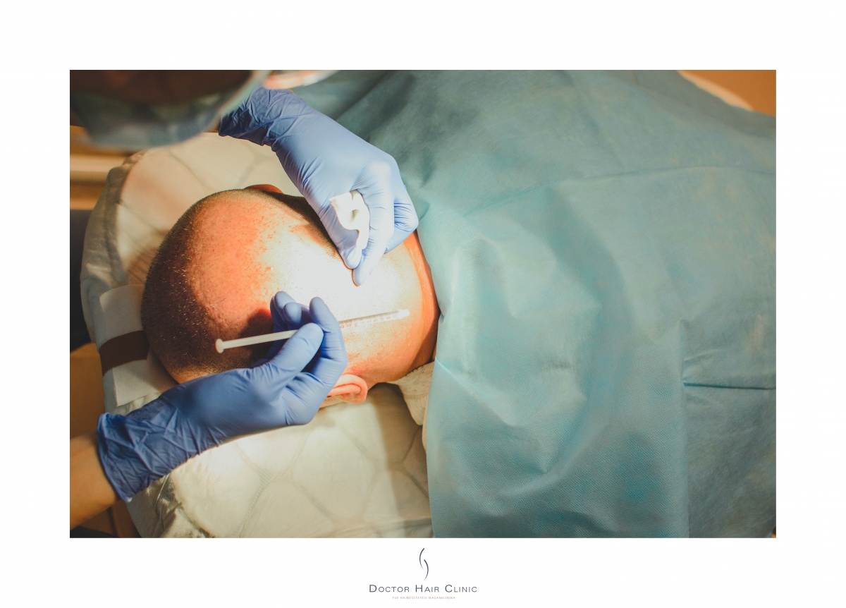 FUE hajbeültetés menete